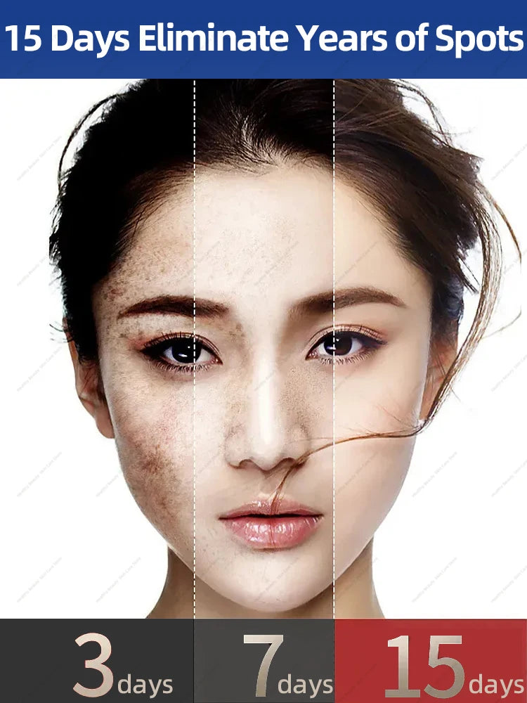 Freckles Removal Cream Dark Spot Remover for Face Melasma Removal Depigmenting