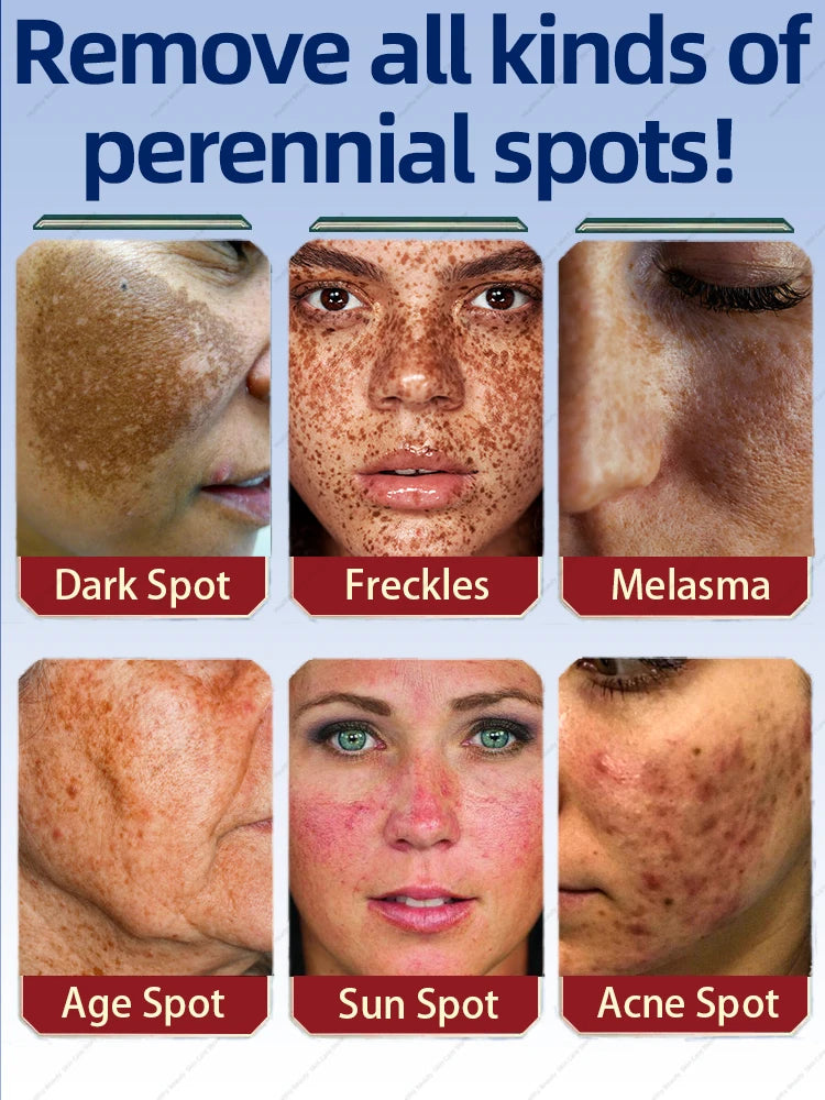 Freckles Removal Cream Dark Spot Remover for Face Melasma Removal Depigmenting