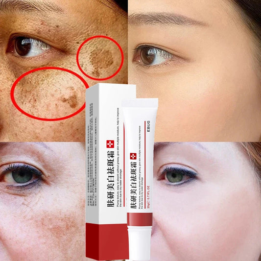 Effective Whitening Freckle Cream Remove Dark Spots Anti Freckle Cream Fade Pigmentation Melasma Brighten Creams Skin Care 20g