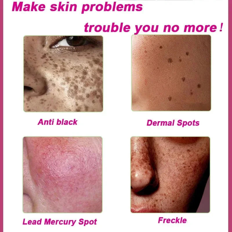 Astragalus Whitening Freckles Cream Face Dark Spots Remover Repair Products Removal Melasma Melanin Moisturiz Brighten Skin Care