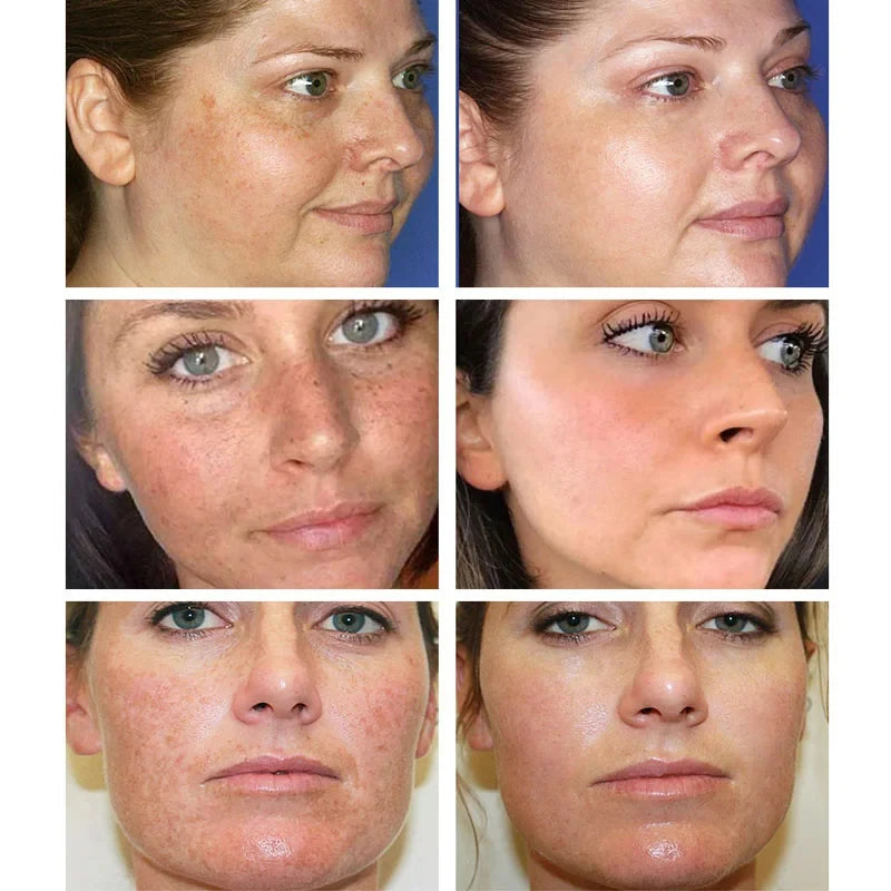 Effective Whitening Freckle Cream Remove Melasma Dark Spots Cream Fade Melanin Moisturize Brighten Smooth Beauty Face Skin Care