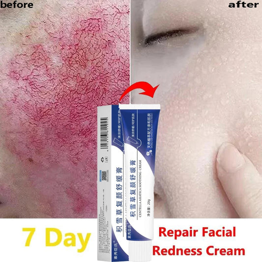 Fast Repair Facial Redness Cream Soothing Red Blood Rosacea Treatment Improve Sensitive Skin Moisturizing Beauty Care Cosmetics