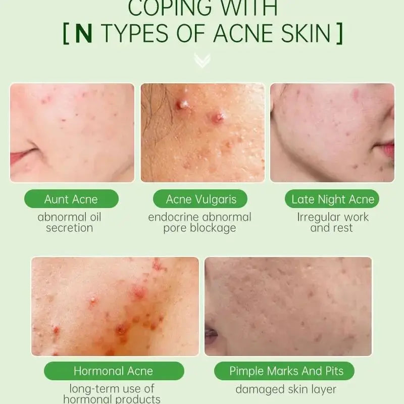 Tea Tree Acne Removal Serum Repair Acne Serum Oil Shrink Pore Remove Blackheads Facial Cleaning Fade Acne Marks Whitening