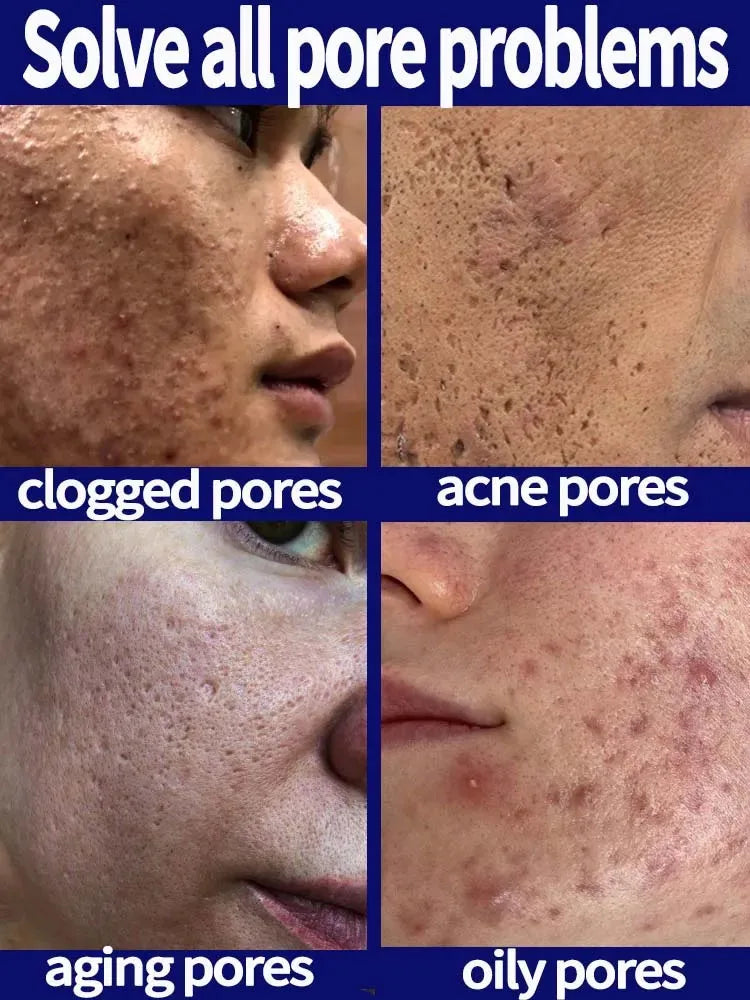 Acidity Pore Shrink Face Serum Remove Blackheads Acne Oil Control Repair Essence Moisturizing Nourish Pores Firming Facial Care