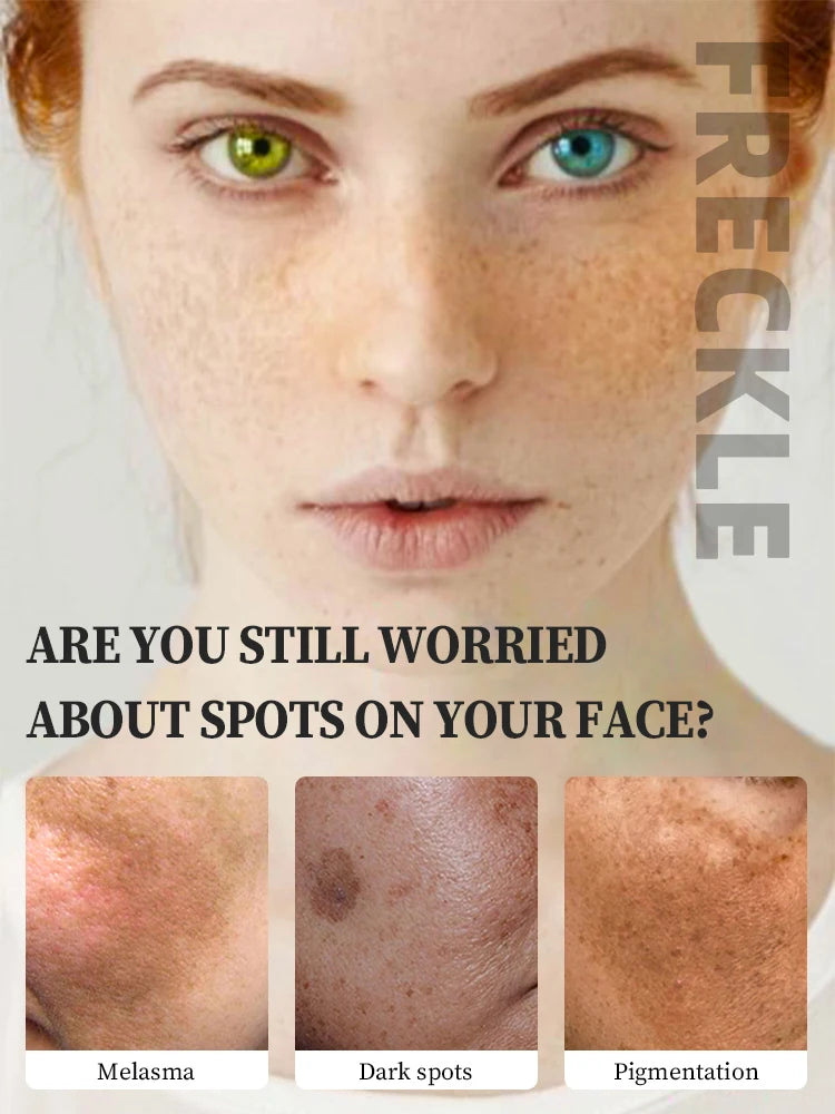 freckle cream remove freckles Melasma dark spots for face