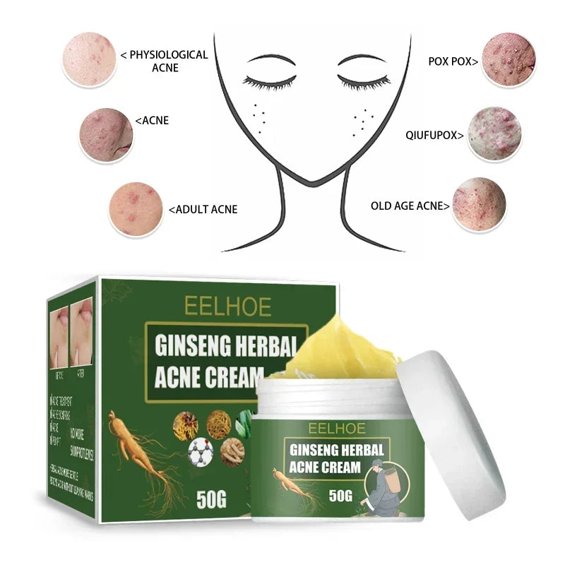 Ginseng Herb Acne Removal Cream Treatment Pimple Scar Spots Shrink Pores Oil Control Whitening Moisturize Face Acne Skin Care