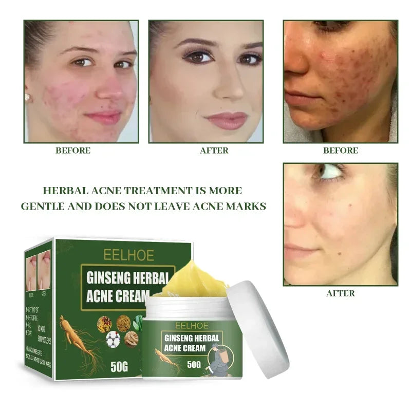 Ginseng Herb Acne Removal Cream Treatment Pimple Scar Spots Shrink Pores Oil Control Whitening Moisturize Face Acne Skin Care