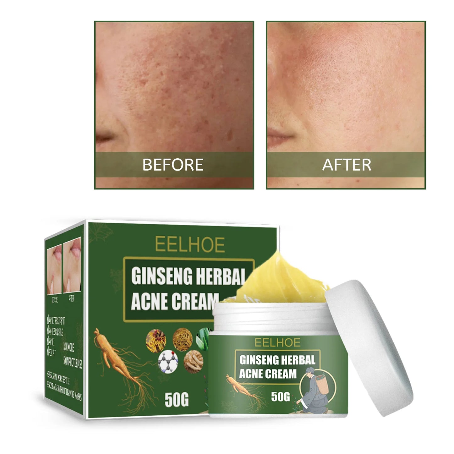 EELHOE Ginseng Herb Acne Removal Cream Treatment Pimple Scar Spots Shrink Pores Oil Control Whitening Moisturizing Face Acne 50g