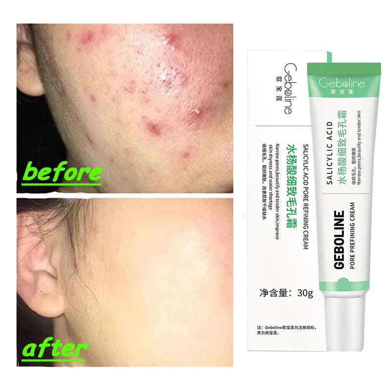 Salicylic Acid Pore Shrinking Cream Quick Elimination Large Pores Remove Blackehead Tighten Face Smooth Skin Korean Care Product