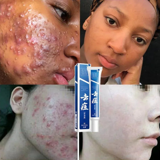 Salicylic Acid  Solution Essence 10mL Shrink pores and Acne Spot Removing Shrink Pores Oil-Control Brighten Face Skin Makeup