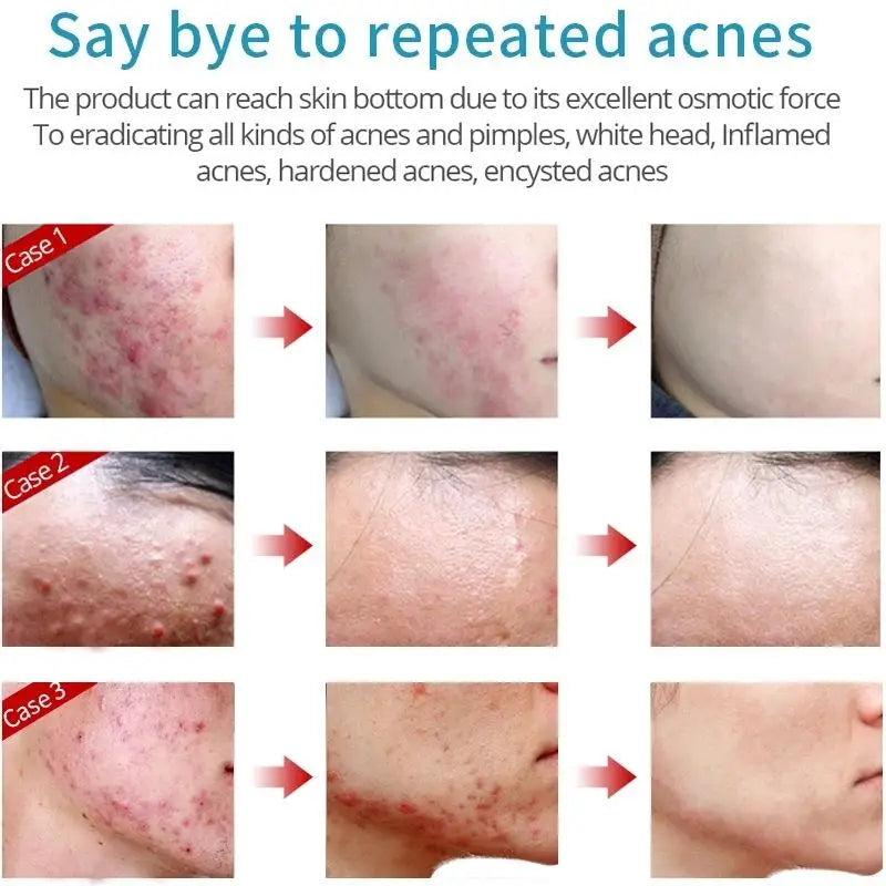 Acne removing cream regulates acne muscles, removes acne, desalinates acne marks, moisturizes and repairs face cream acne