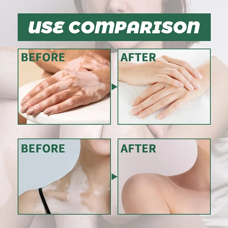 Vitiligo Ointment Herbal Extract Remove Ringworm White Spot Removal Skin Vitiligo Eliminate Vitiligo Treatment Cream