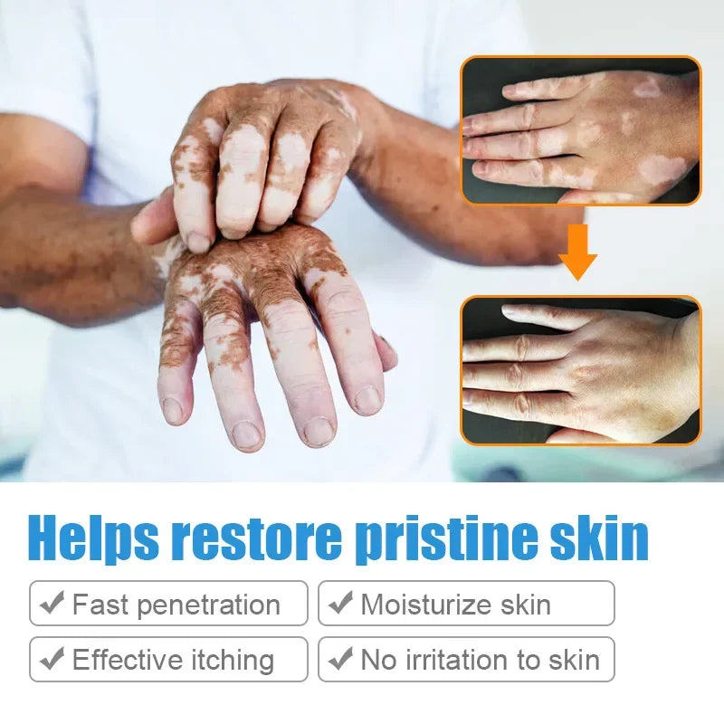 Vitiligo Ointment Herbal Extract Remove Ringworm White Spot Removal Skin Vitiligo Eliminate Vitiligo Treatment Cream